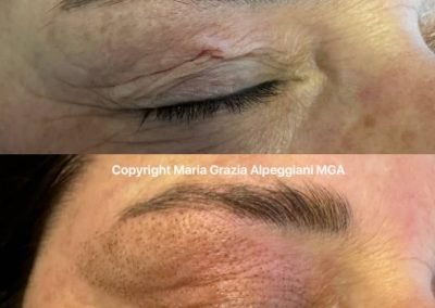 blefaro non chirurgica occhio chiuso