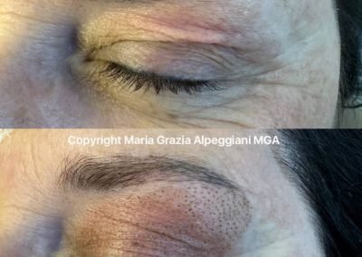 blefaro non chirurgica palpebra