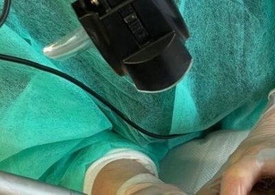 durante dermopigmentazione alopecia