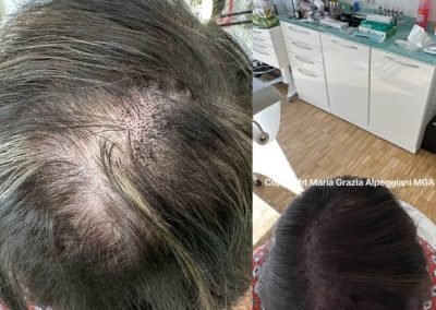 infoltimento con tricopigmentazione donna