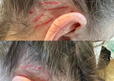 tricopigmentazione donna copertura cicatrici e diradamenti