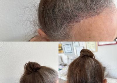 infoltimento tricopigmentazione attaccatura