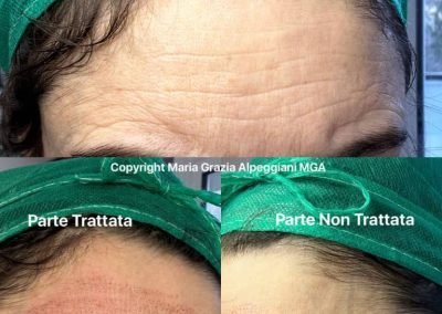 lifting fronte plasma pen