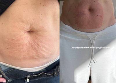 lifting non chirurgico lassita╠Ç e smagliature 2