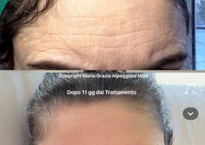 post trattamento lifting fronte