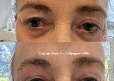 prima e dopo lifting non chir palpebra sinistra