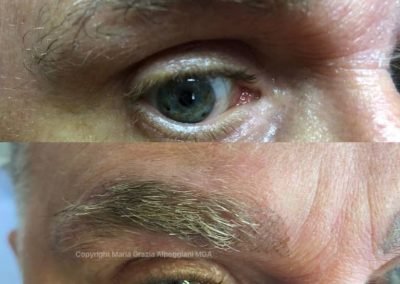 ricostr su alopecia areata uomo