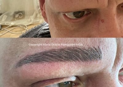 ricostr tot su alopecia uomo