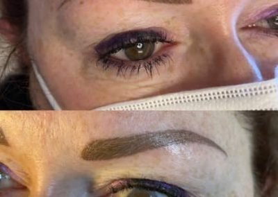 ricostruzione totale sopraccigliare