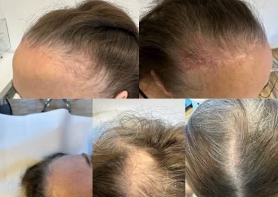 tricopigmentazione donna copertura cicatrici e diradamenti