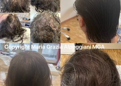 tricopigmentazione donna su diradamento