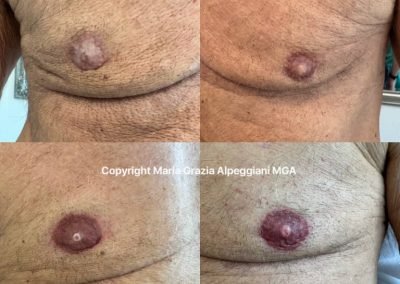 Ricostruzione Areolare Seno Uomo