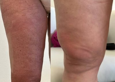 eliminazione cellulite e riduzione circonferenza cosce