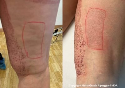 eliminazione edemi riduzione centimetri e lifting cosce