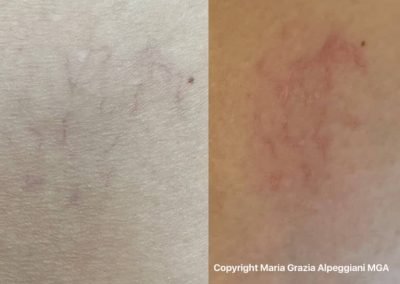eliminazione teleangectasie capillari