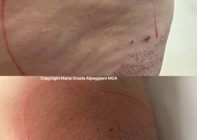 lifting non chirurgico glutei