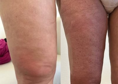 riduzione cosce e ginocchia